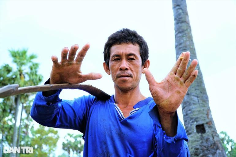 "Chiến tích" hơn 20 trèo cây thốt nốt lấy mật của ông Nguyễn Văn Út (Ảnh: Bảo Kỳ). "Chiến tích" hơn 20 trèo cây thốt nốt lấy mật của ông Nguyễn Văn Út (Ảnh: Bảo Kỳ).