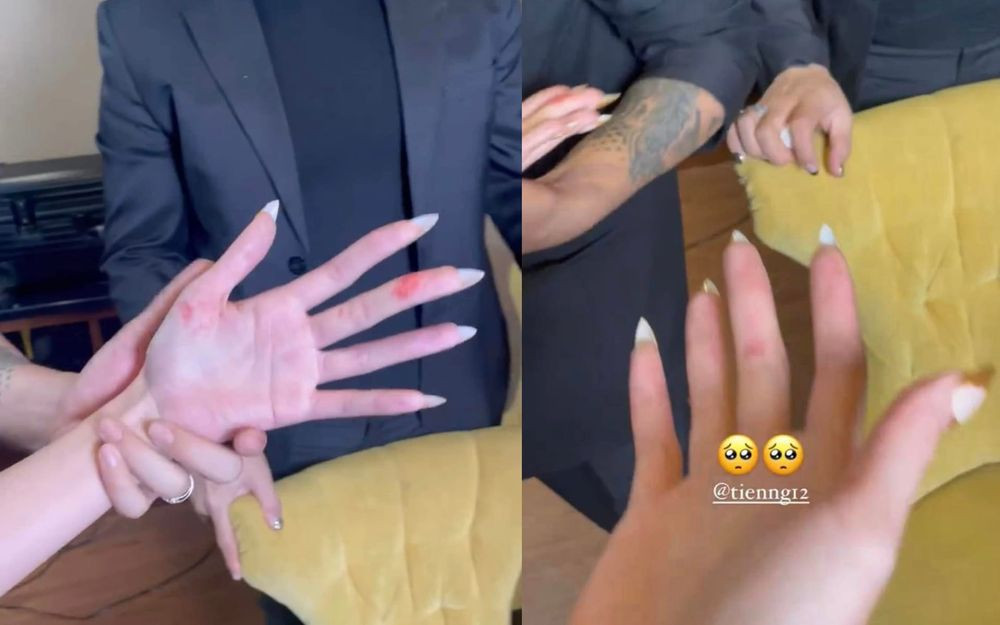 Thùy Tiên bị chảy máu do trang phục biểu diễn cứa vào tay.