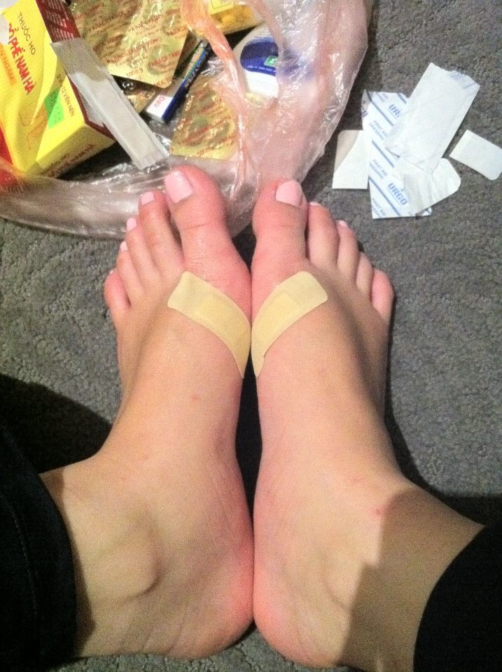 Chân của Trương Tùng Lan phải dán eugo cho đỡ đau tấy Chân của Trương Tùng Lan phải dán eugo cho đỡ đau tấy