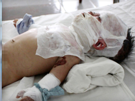 Bé gái 10 tháng tuổi bò ra mé giường rồi ngã úp mặt vào nồi cơm điện đang sôi dưới đất khiến em bị bỏng nặng. Ảnh: chỉ mang tính minh họa Bé gái 10 tháng tuổi bò ra mé giường rồi ngã úp mặt vào nồi cơm điện đang sôi dưới đất khiến em bị bỏng nặng