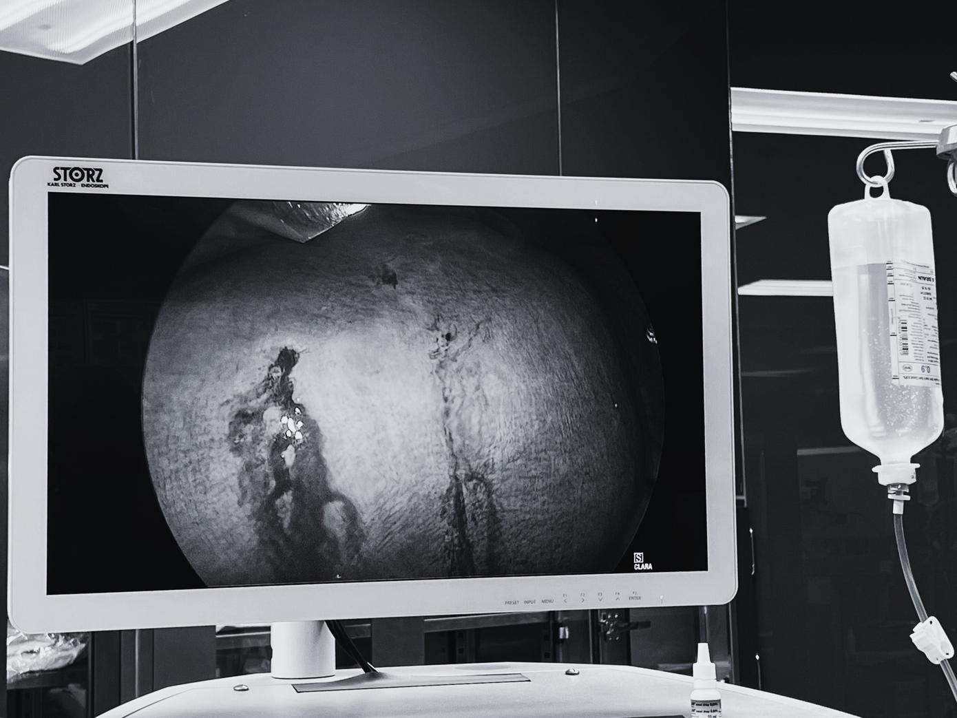 Hình ảnh nội soi khối u 110mm của bệnh nhân T.T.N.H