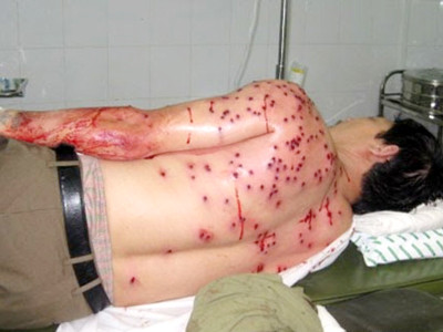 Nạn nhân của Súng Săm lét