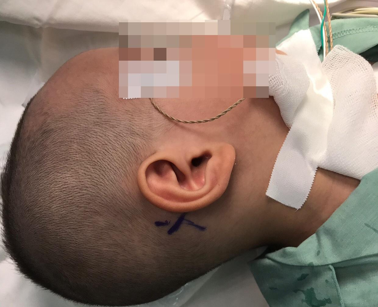 Bệnh nhi được 2 bệnh viện phối hợp chuyên môn thực hiện phương pháp cấy điện cực ốc tai Bệnh nhi được 2 bệnh viện phối hợp chuyên môn thực hiện phương pháp cấy điện cực ốc tai