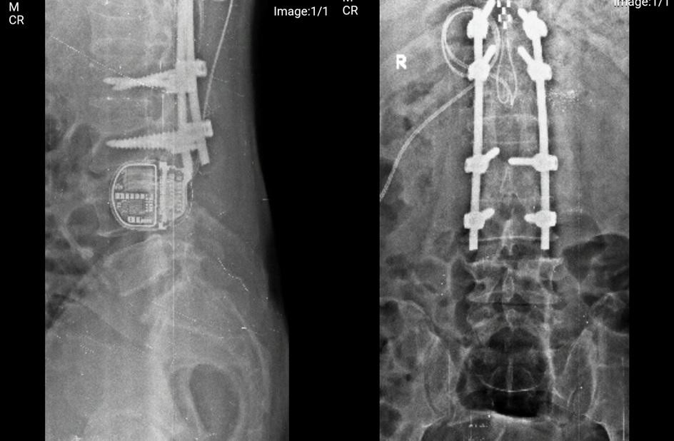 Hình ảnh kiểm tra cho thấy thiết bị điều trị đau có tổng chi phí lên tới 850 triệu đồng trong cơ thể người bệnh Hình ảnh kiểm tra cho thấy thiết bị điều trị đau có tổng chi phí lên tới 850 triệu đồng trong cơ thể người bệnh