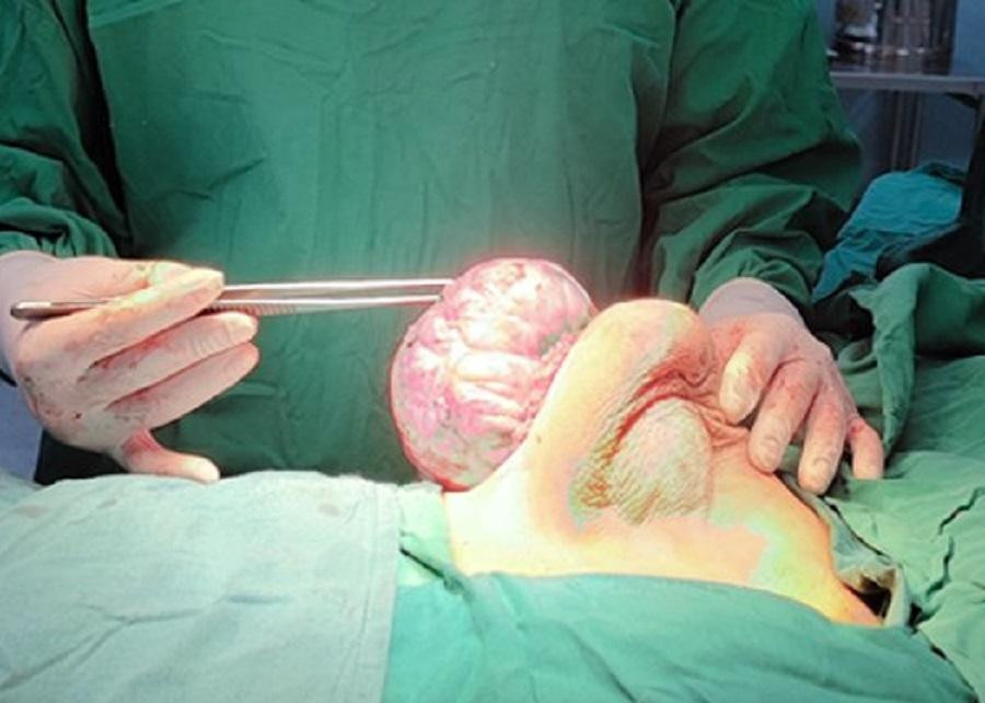 Khối u lớn trên ngực bệnh nhân đã được bác sĩ bóc thành công trong cuộc mổ (ảnh: BVCC) Khối u lớn trên ngực bệnh nhân đã được bác sĩ bóc thành công trong cuộc mổ (ảnh: BVCC)