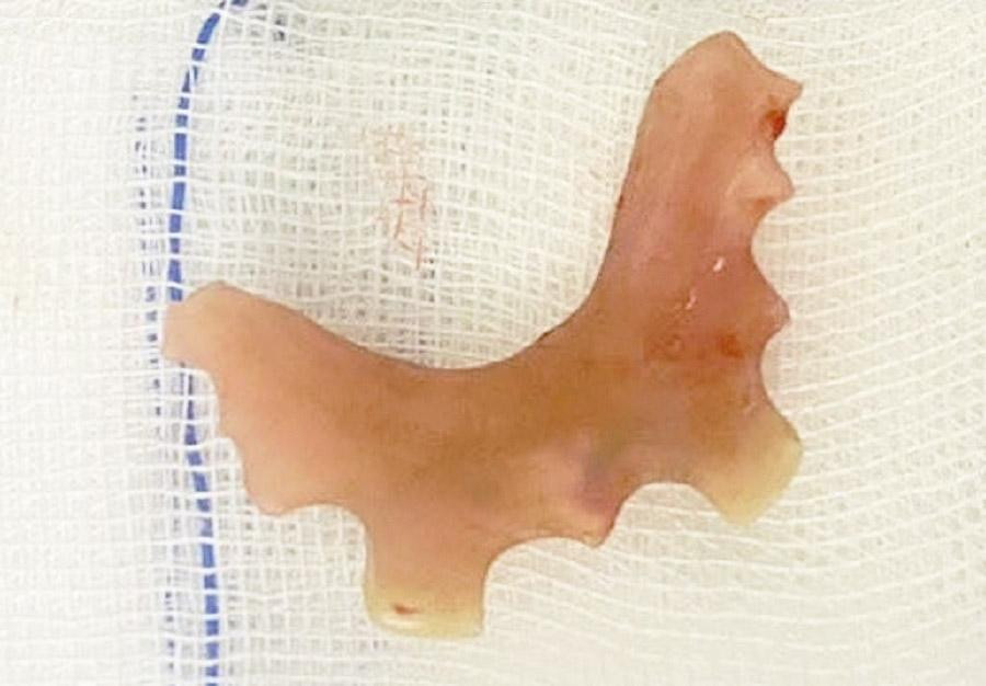 Hàm răng giả được bác sĩ nội soi gắp từ thực quản của bệnh nhân ra ngoài (ảnh: BVCC) Hàm răng giả được bác sĩ nội soi gắp từ thực quản của bệnh nhân ra ngoài (ảnh: BVCC)