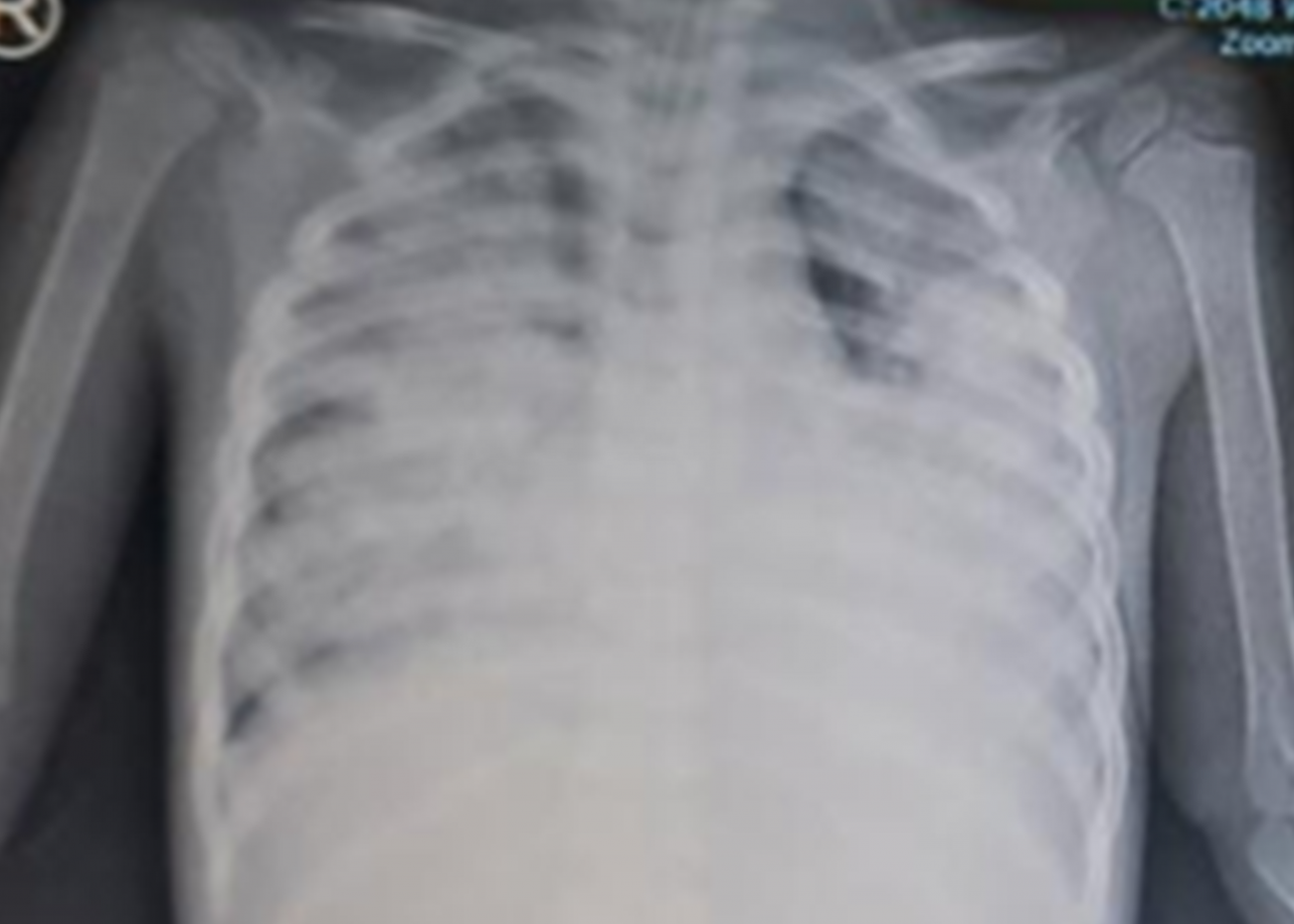 Hình ảnh X-quang cho thấy cả 2 bên phổi của bệnh nhi bị tổn thương nghiêm trọng