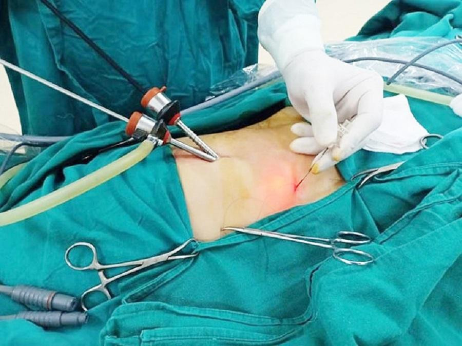 Bác sĩ thực hiện nội soi cắt túi mật cho người bệnh tại Bệnh viện Bình Dân TPHCM Bác sĩ thực hiện nội soi cắt túi mật cho người bệnh tại Bệnh viện Bình Dân TPHCM