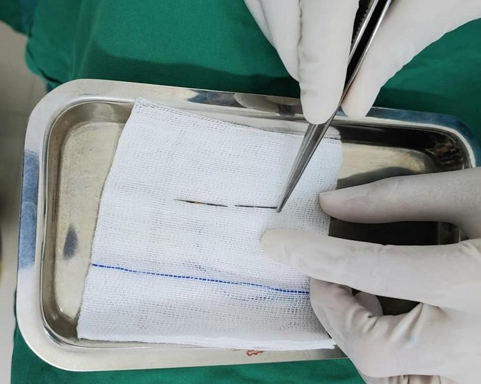 Chiếc kim khâu gỉ sét được bác sĩ thực hiện nội soi gắp ra ngoài thành công Chiếc kim khâu gỉ sét được bác sĩ thực hiện nội soi gắp ra ngoài thành công