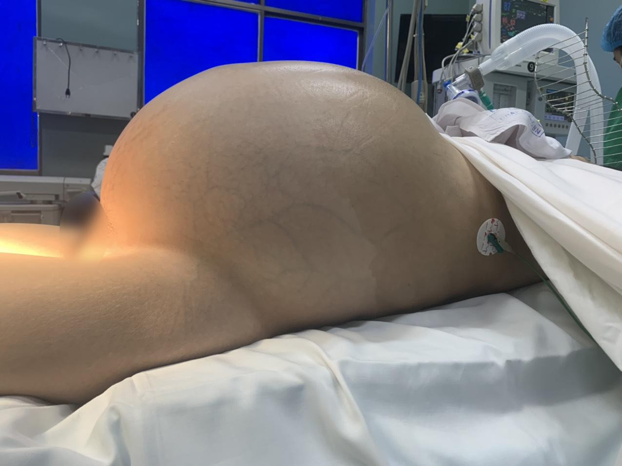 Vùng bụng bệnh nhân phình lớn, căng cứng tại thời điểm bác sĩ chuẩn bị thực hiện cuộc phẫu thuật