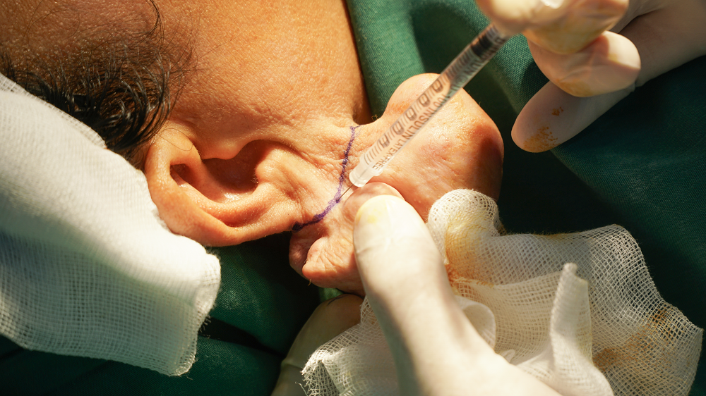 Bệnh nhân được bác sĩ chỉ định thực hiện phẫu thuật cắt khối dị dạng Bệnh nhân được bác sĩ chỉ định thực hiện phẫu thuật cắt khối dị dạng