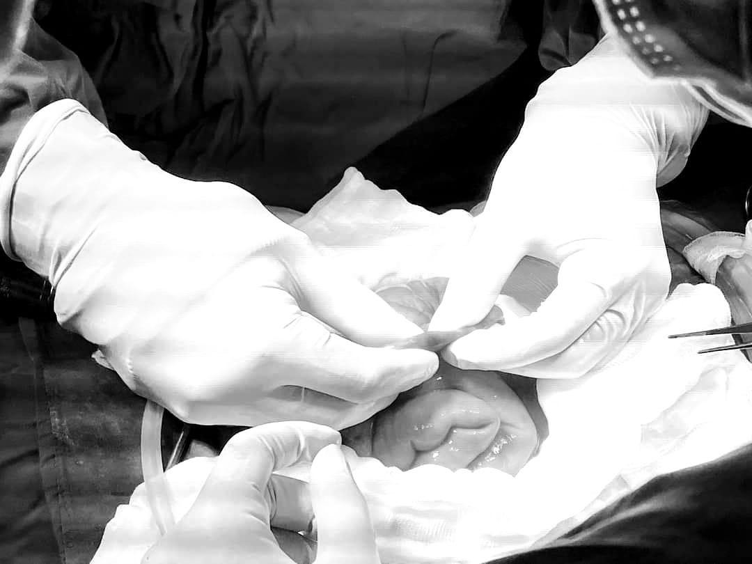 Các bác sĩ đã cắt vị trí ruột non bị vỡ dị dạng mạch máu và nối lại thành công (ảnh: BVCC) Các bác sĩ đã cắt vị trí ruột non bị vỡ dị dạng mạch máu và nối lại thành công (ảnh: BVCC)