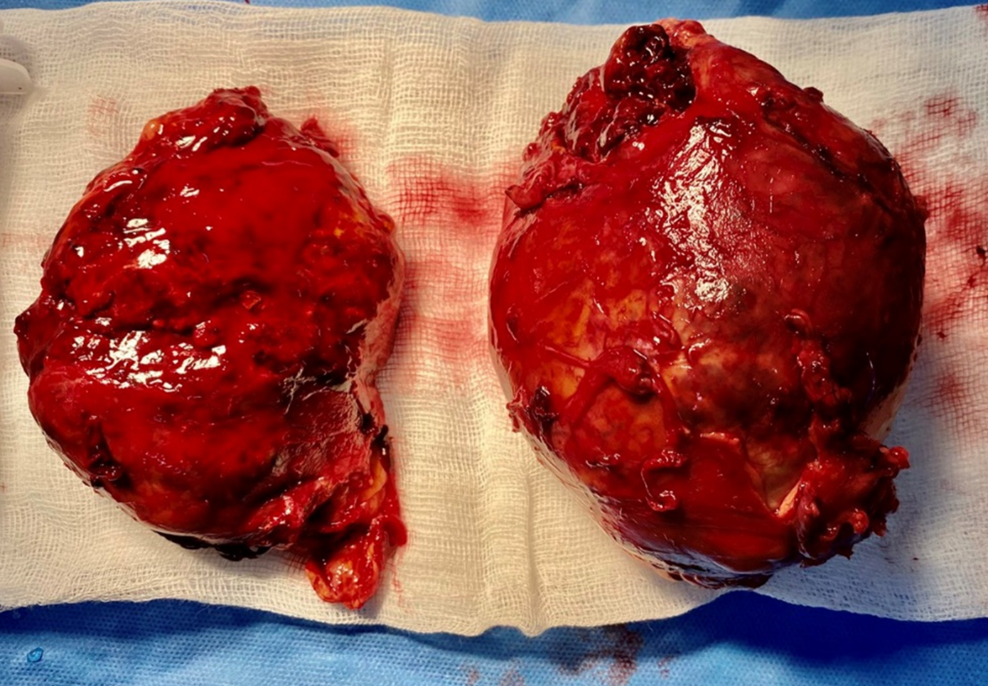 2 khối bướu thượng thận có kích thước rất lớn được bóc thành công khỏi cơ thể bệnh nhân