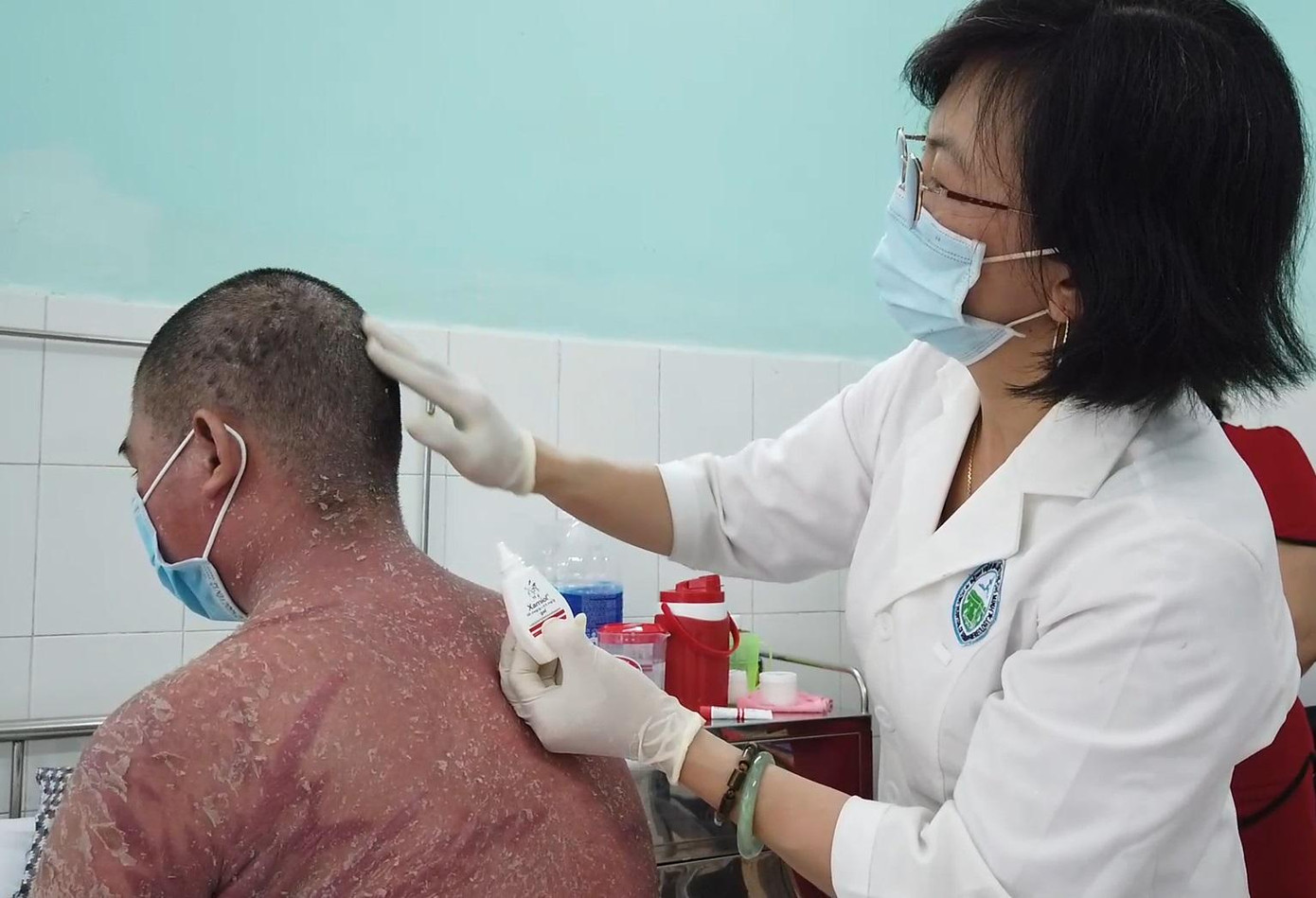 Bệnh nhân nhập viện trong tình trạng toàn thân bị bong tróc da sau điều trị vảy nến bằng thuốc mua trên mạng xã hội