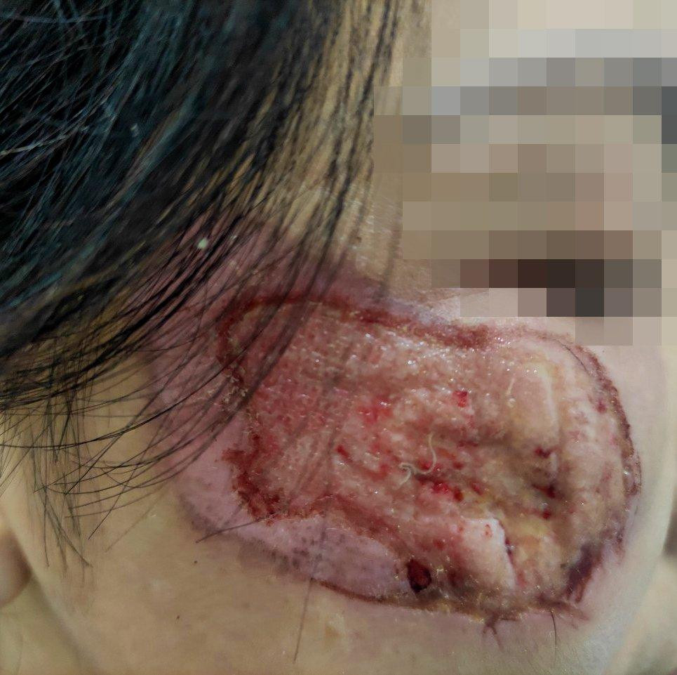 Vùng da mặt của bệnh nhân bị tổn thương nghiêm trọng sau khi trị nám bằng thuốc chứa a xít Vùng da mặt của bệnh nhân bị tổn thương nghiêm trọng sau khi trị nám bằng thuốc chứa a xít