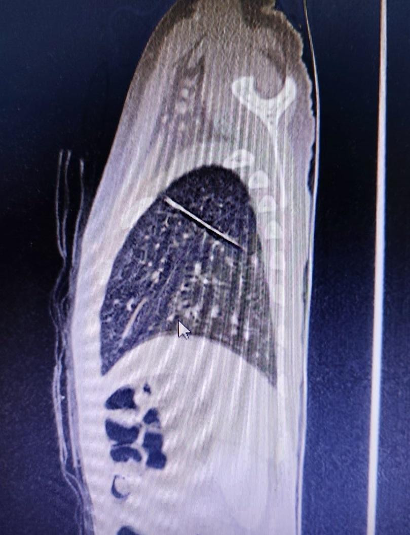 Dị vật là chiếc kim (hình ảnh cản quang) nằm trong nhu mô phổi của bệnh nhi Dị vật là chiếc kim (hình ảnh cản quang) nằm trong nhu mô phổi của bệnh nhi