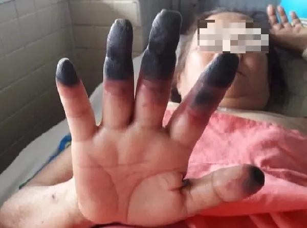 Một trường hợp tại Bình Thuận bị tắc mạch máu dẫn đến hoại tử chi từng điều trị tại TPHCM Một trường hợp tại Bình Thuận bị tắc mạch máu dẫn đến hoại tử chi từng điều trị tại TPHCM