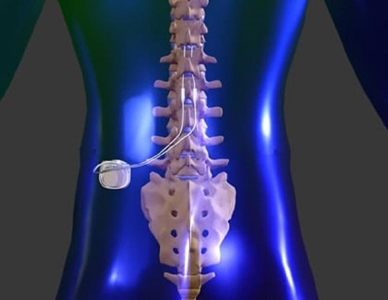 Hình ảnh minh họa thiết bị phát xung điện sẽ được đặt vào cơ thể người bệnh để điều trị đau Hình ảnh minh họa thiết bị phát xung điện sẽ được đặt vào cơ thể người bệnh để điều trị đau