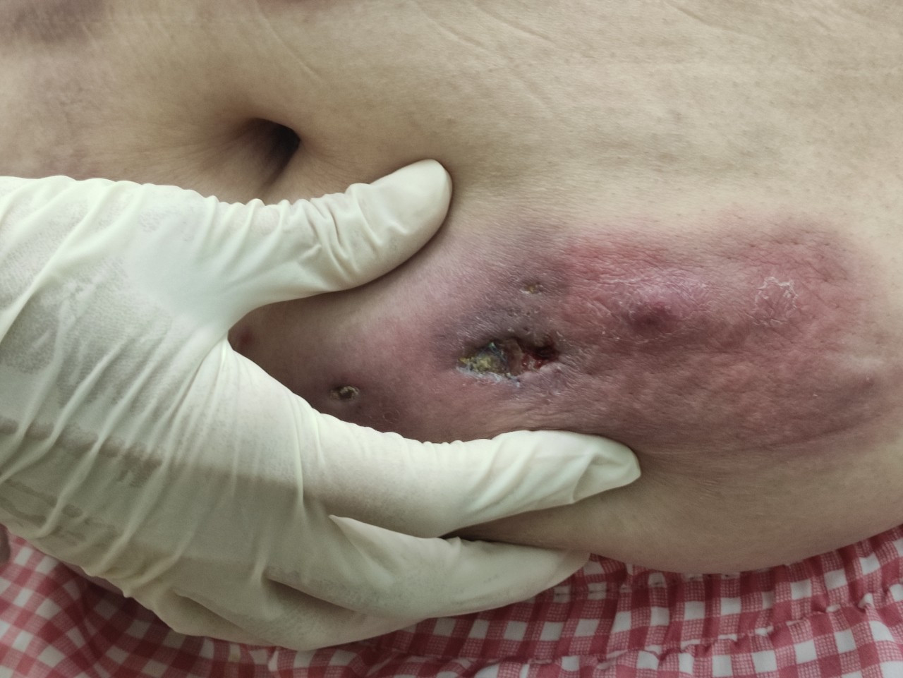 Vùng bụng bệnh nhân nhiễm trùng, hoại tử nặng sau tiêm chất làm đầy Vùng bụng bệnh nhân nhiễm trùng, hoại tử nặng sau tiêm chất làm đầy