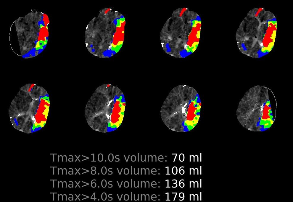 Kết quả phân tích của phần mềm trí tuệ nhân tạo về nguy cơ chết não của một ca bệnh đột quỵ Kết quả phân tích của phần mềm trí tuệ nhân tạo về nguy cơ chết não của một ca bệnh đột quỵ