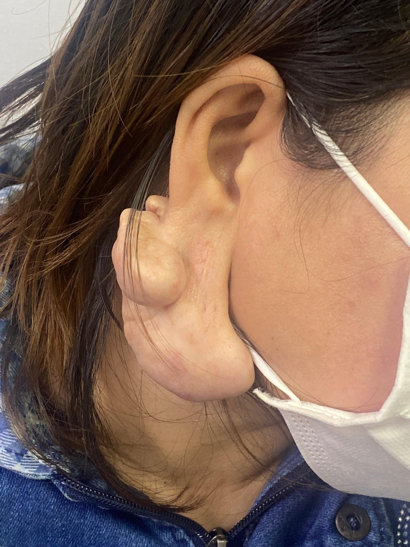 Tai bên phải phì đại gây mất thẩm mỹ và bất tiện trong sinh hoạt thường ngày cho người bệnh Tai bên phải phì đại gây mất thẩm mỹ và bất tiện trong sinh hoạt thường ngày cho người bệnh