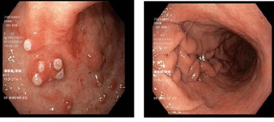 Kết quả (trước và sau điều trị) vị trí giãn mao mạch hang vị ở bệnh nhân Kết quả (trước và sau điều trị) vị trí giãn mao mạch hang vị ở bệnh nhân