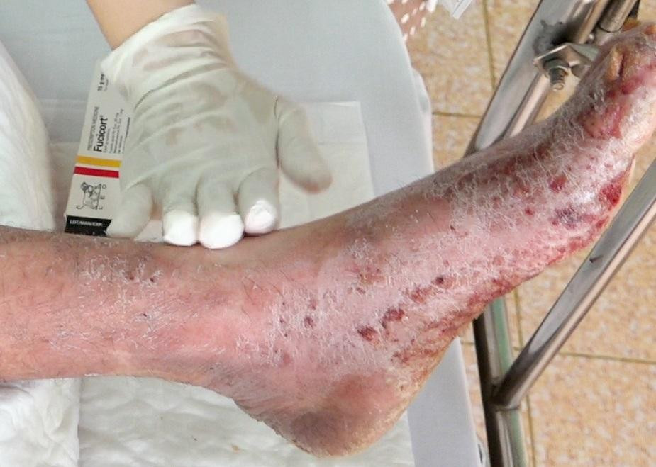 Nam bệnh nhân nhập viện với cơ thể bị bong tróc da gây nhiễm trùng nặng Nam bệnh nhân nhập viện với cơ thể bị bong tróc da gây nhiễm trùng nặng