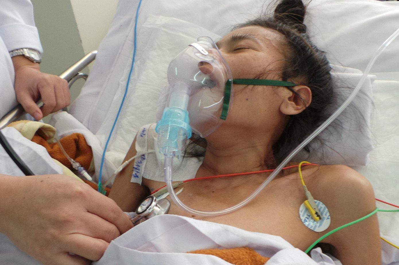 Một trường hợp bệnh nhân rơi vào nguy kịch vì suy tim