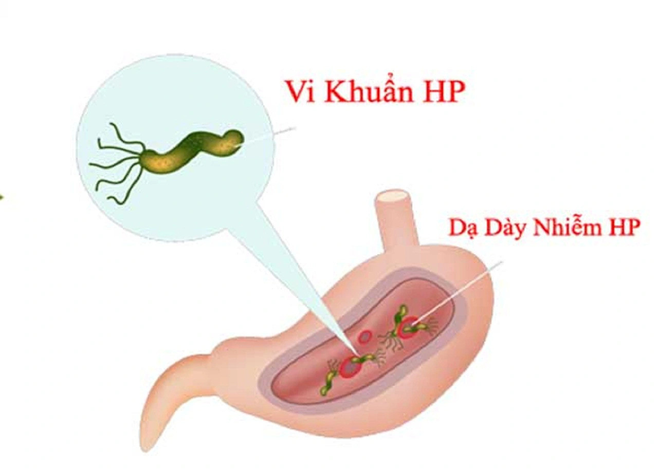 H.P - vi khuẩn hình xoắn ốc - âm thầm trú ngụ trong dạ dày của hơn một nửa dân số thế giới, trở thành "kẻ thầm lặng" gây ra nhiều vấn đề tiêu hóa dai dẳng, kể cả ở trẻ em.
