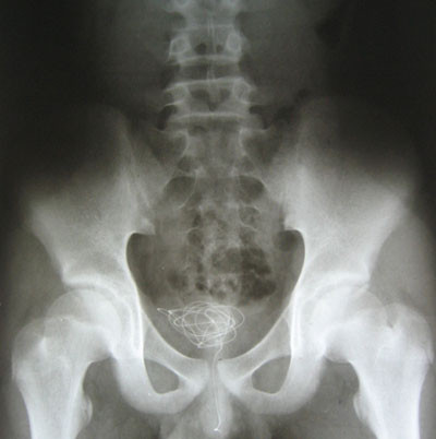 Sợi dây điện nằm gọn trong bàng quang của trẻ