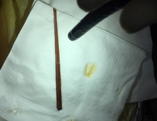 Say rượu, bệnh nhân tâm thần nuốt 6 đoạn nhang vào bụng ảnh 1