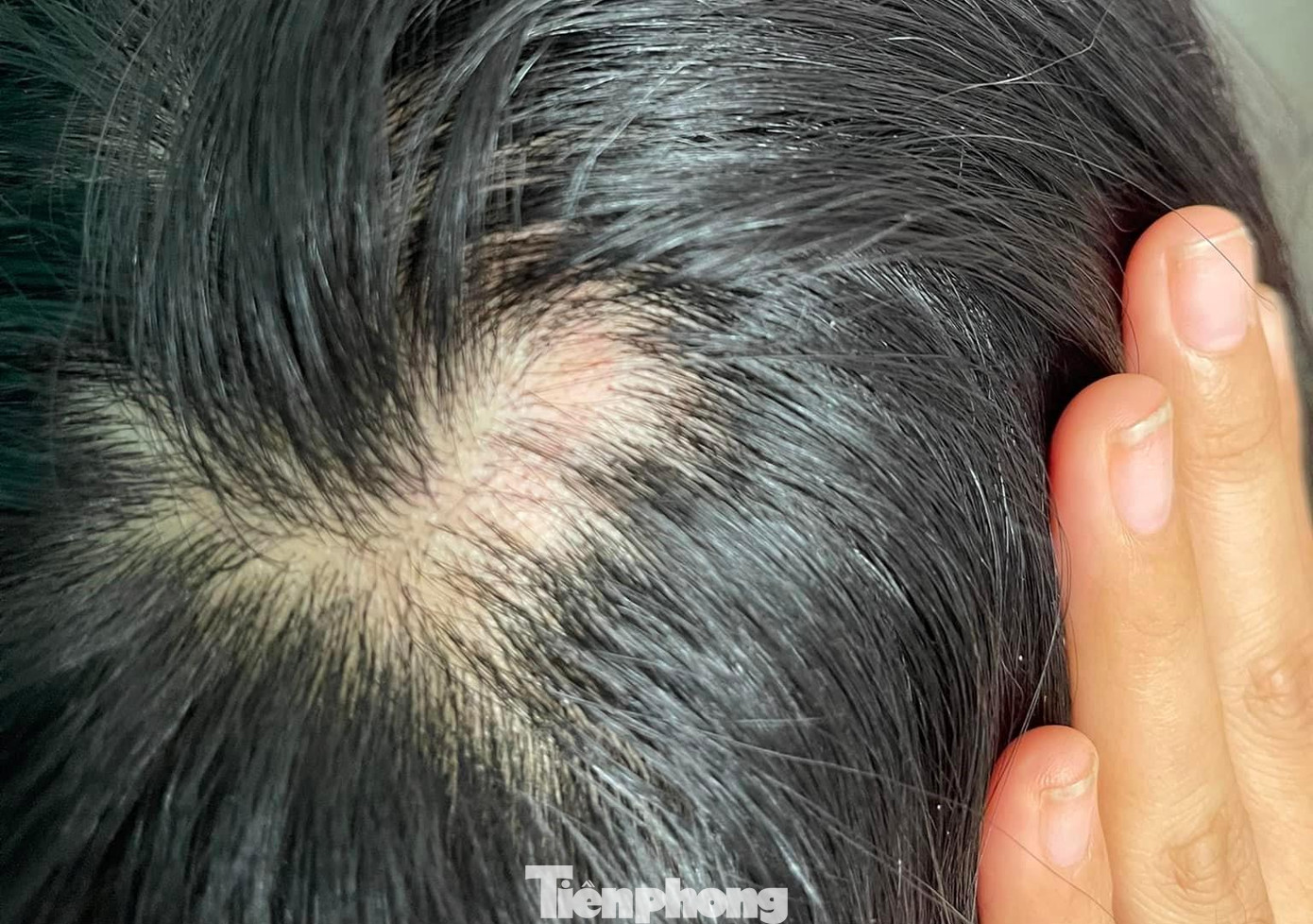 Nạn nhân bị thương vùng đầu