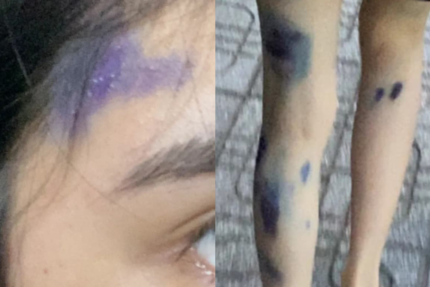 Nhật Hân bị kiến ba khoang cắn ở trán, tay và chân, vết thương lan khá rộng và có mủ.