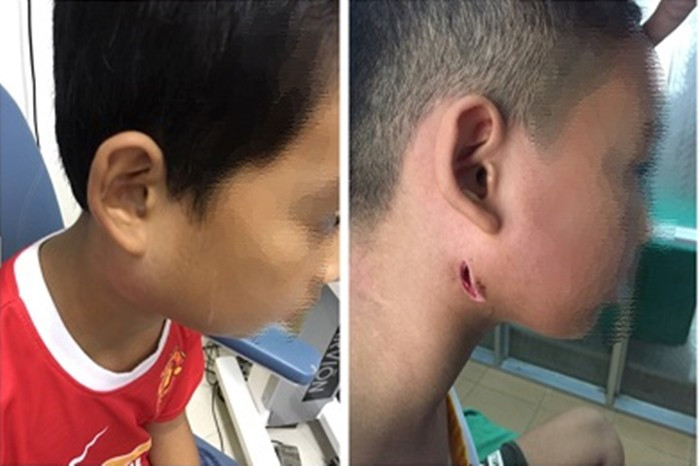 Vi khuẩn 'ăn thịt người': Có thể tử vong sau 48 giờ nhiễm bệnh ảnh 1