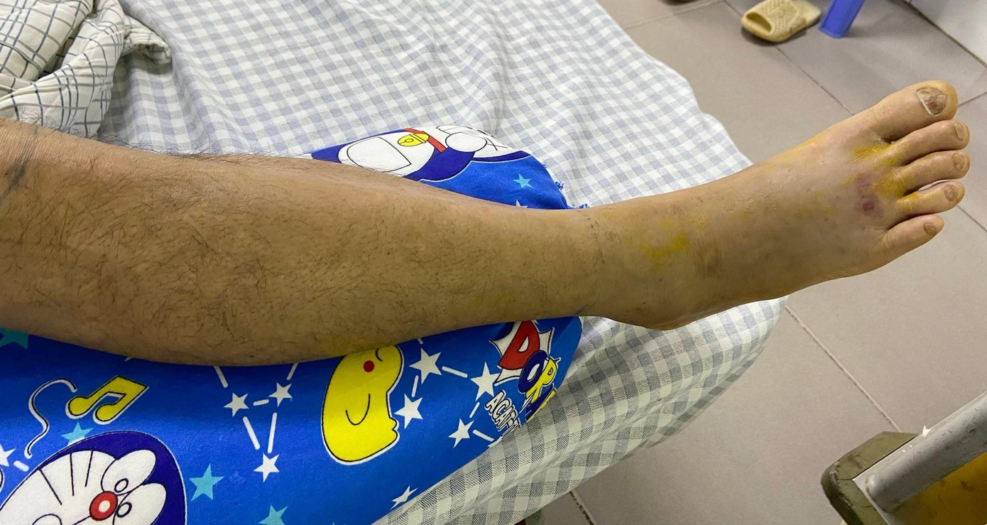 Vết rắn lục tre cắn trên bàn chân của người đàn ông. Ảnh: Bệnh viện cung cấp