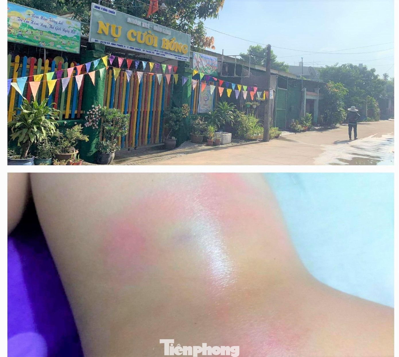 Vết thương của bé gái Vết thương của bé gái