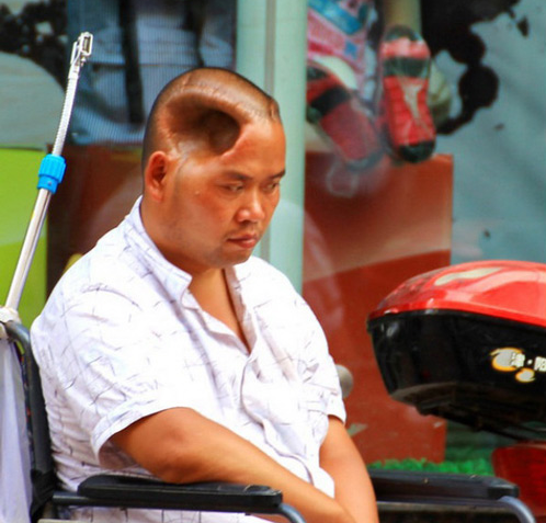 Người đàn ông vẫn sống với lỗ hổng có kích thước tương đương một nắm tay ở trên đầu