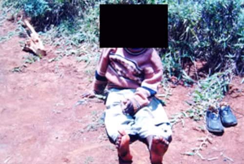 Nạn nhân bị nhiễm AIDS do dùng chung kim lấy bọ