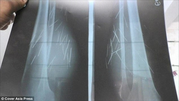 Kỳ lạ người phụ nữ 'sản xuất' cả vốc kim, đinh nhọn trong chân ảnh 3