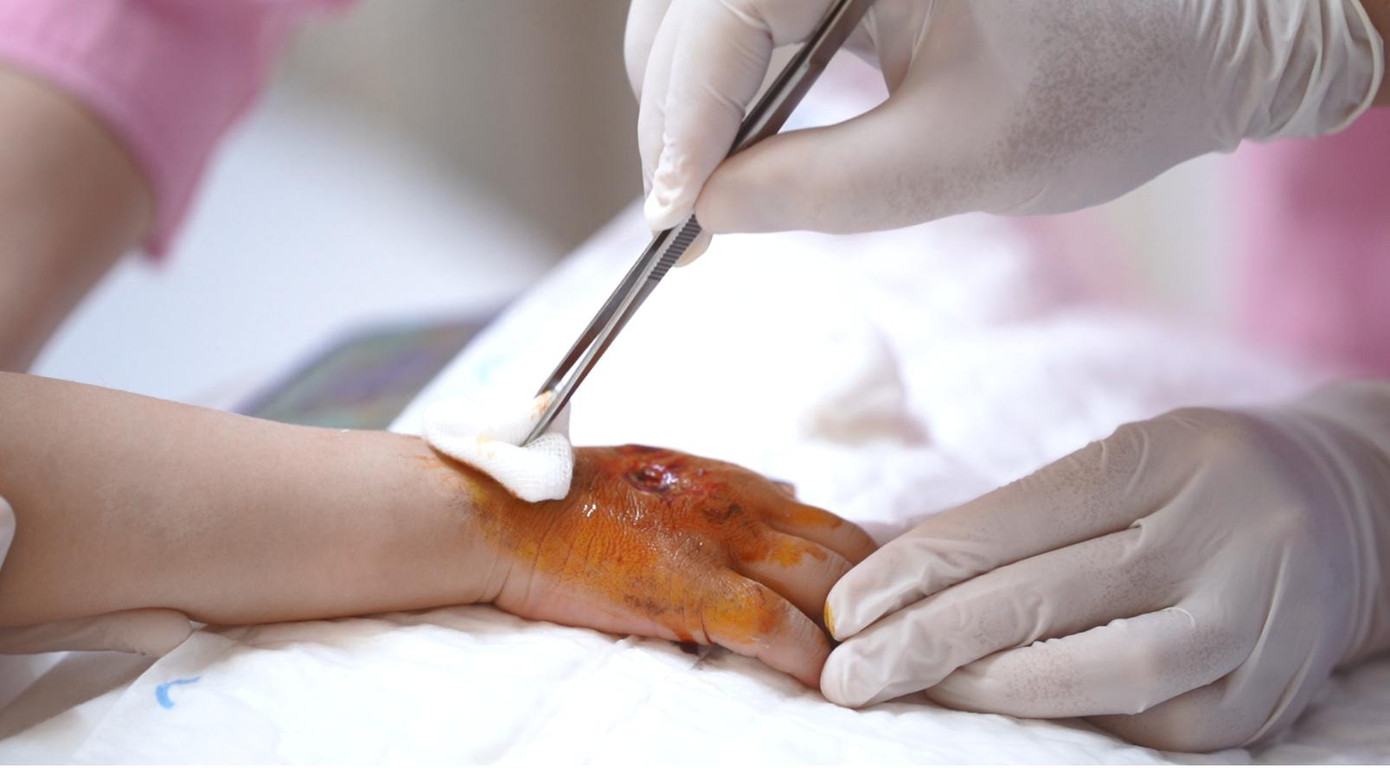 Hình ảnh bàn tay phải của bệnh nhi N.M.V