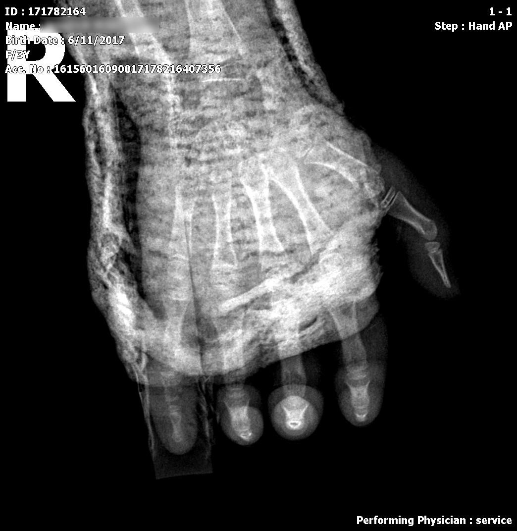 Ảnh chụp X-quang bàn tay phải bệnh nhi N.M.V ngày 13/3/2021