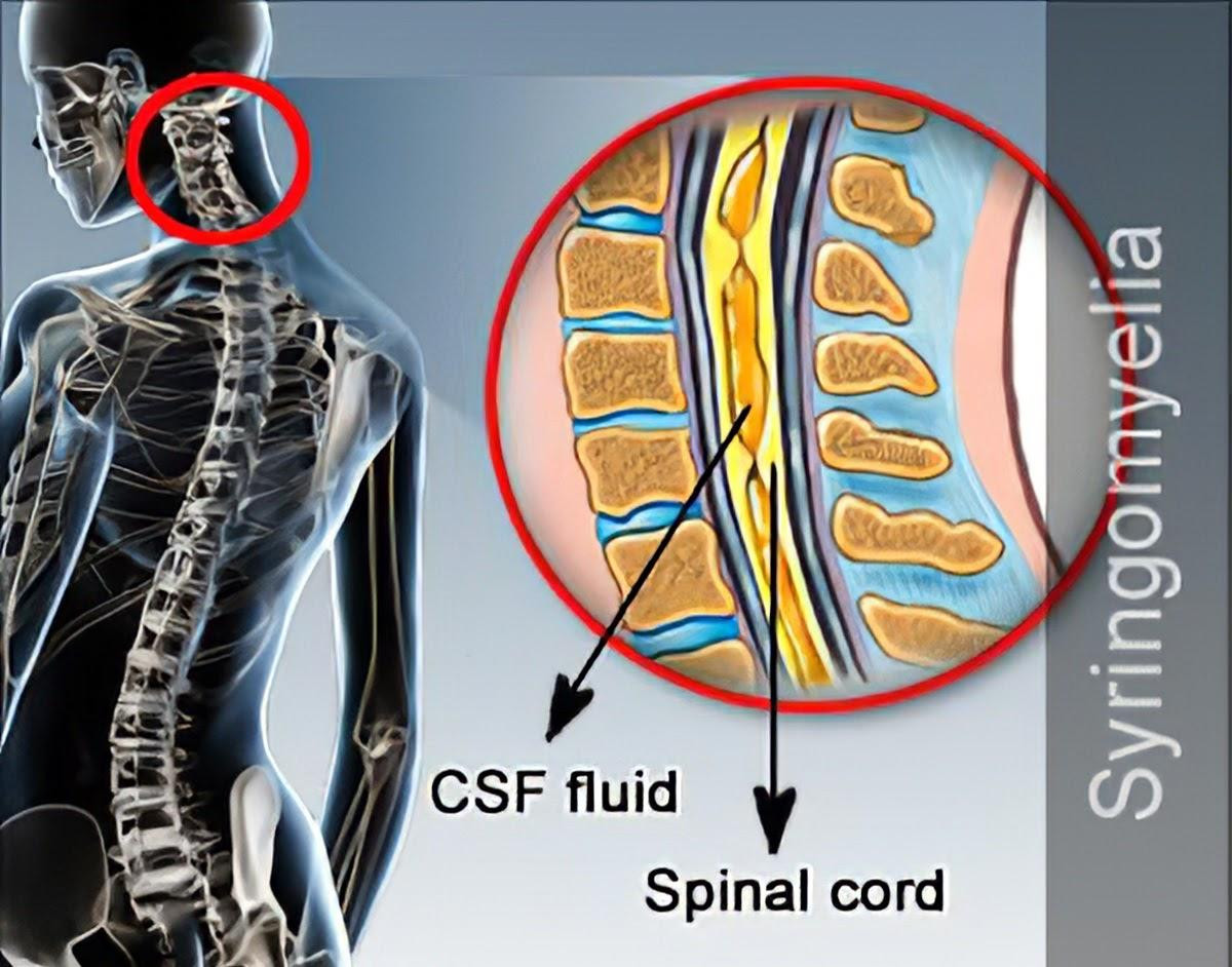 Rỗng tủy do hình thành trong tủy hốc chứa dịch tích lại phát triển dần gây đè ép, tổn thương tủy. (ảnh minh họa)