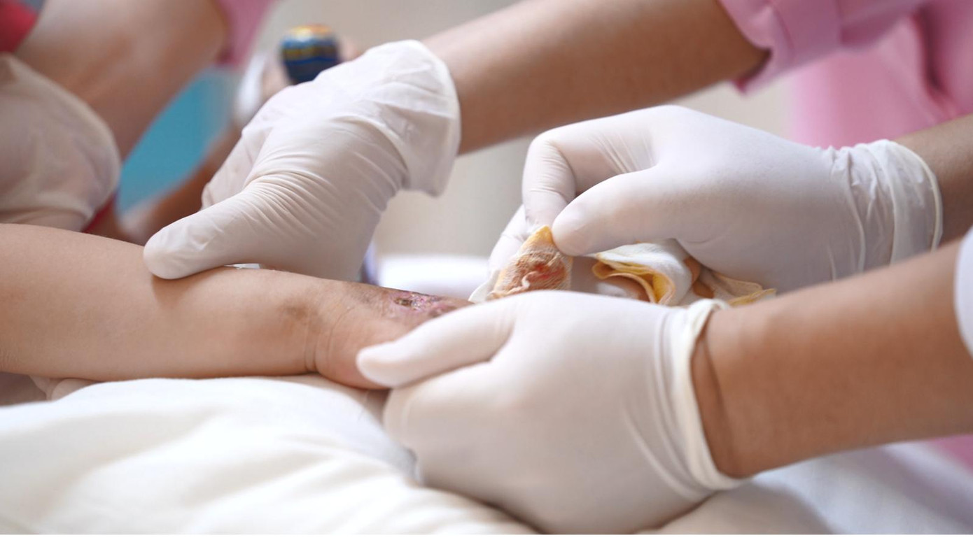 Hình ảnh bàn tay phải của bệnh nhi N.M.V sau phẫu thuật