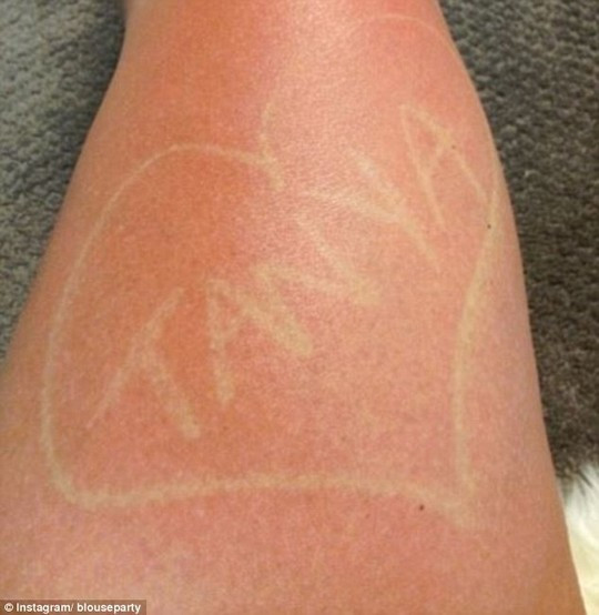 Hiểm họa chết người từ trò 'xăm cháy nắng' mới của giới trẻ ảnh 3