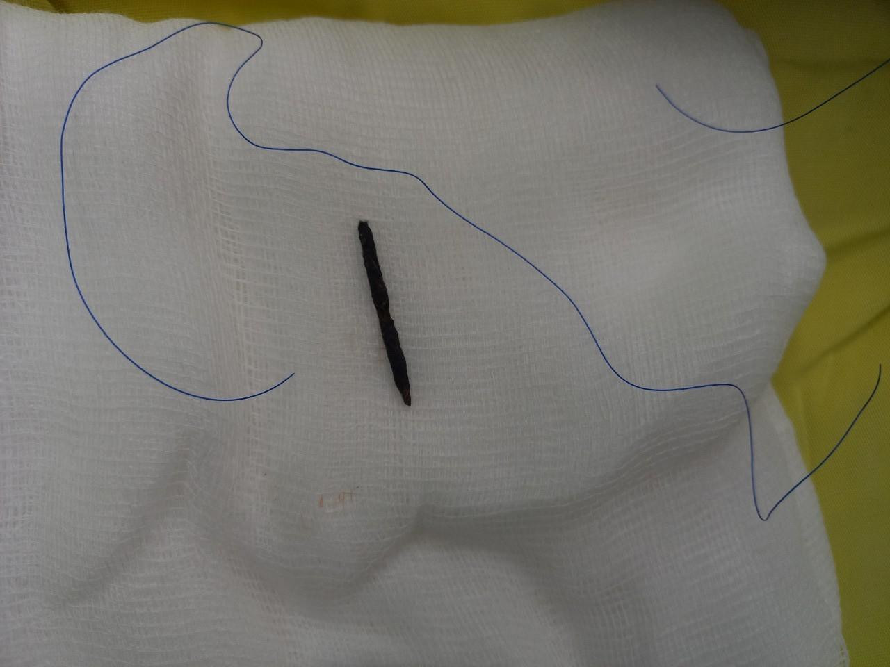 Dị vật là đoạn kẽm gai được lấy ra khỏi cơ thể bệnh nhân.