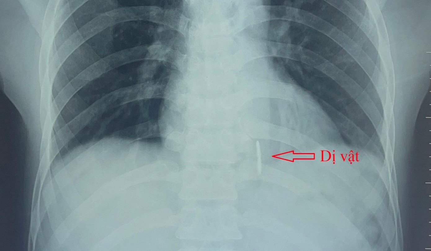 Hình ảnh dị vật qua Xquang.