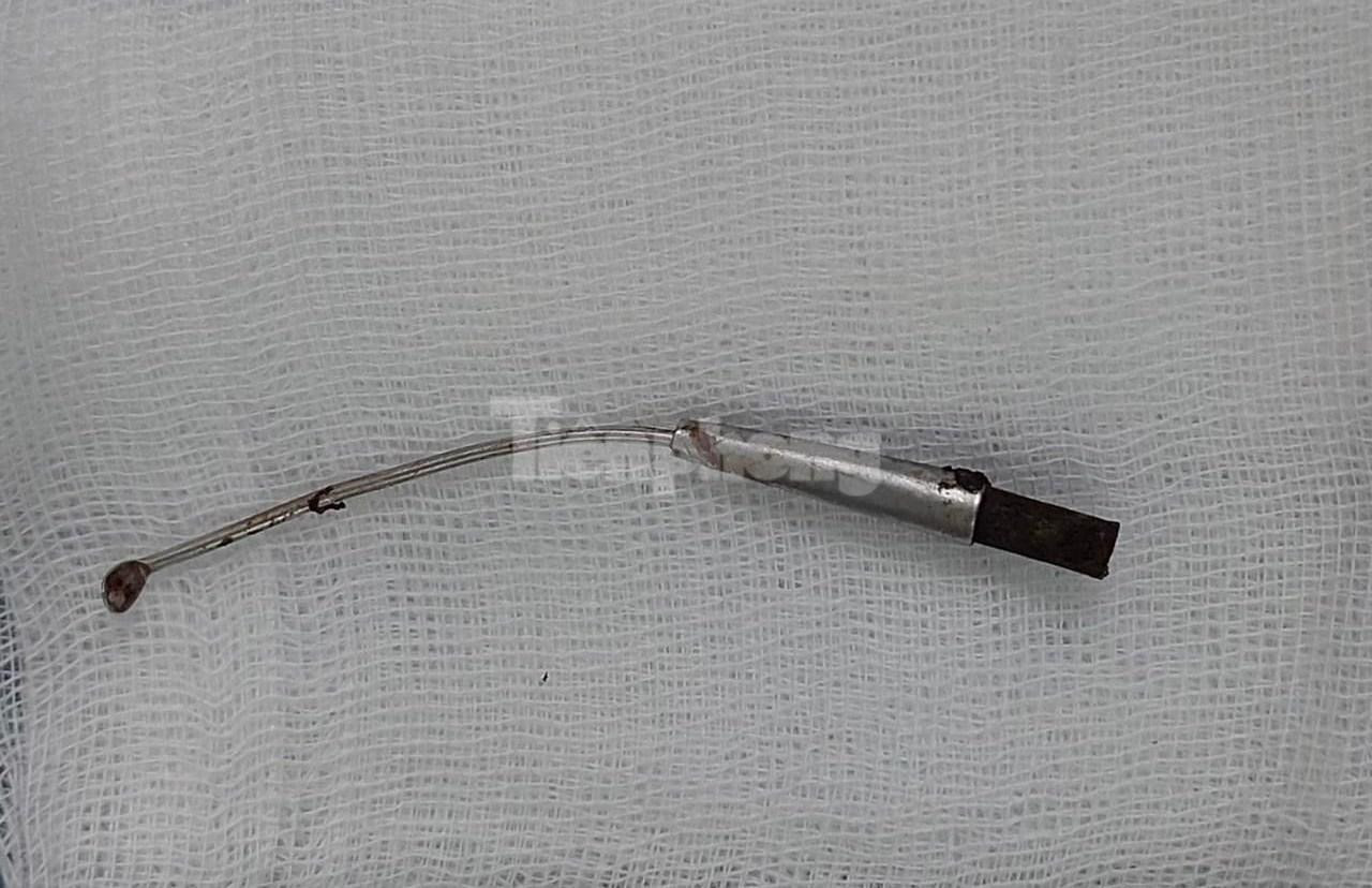 Chiếc que lấy ráy tai bằng kim loại được các bác sĩ lấy ra thành công.