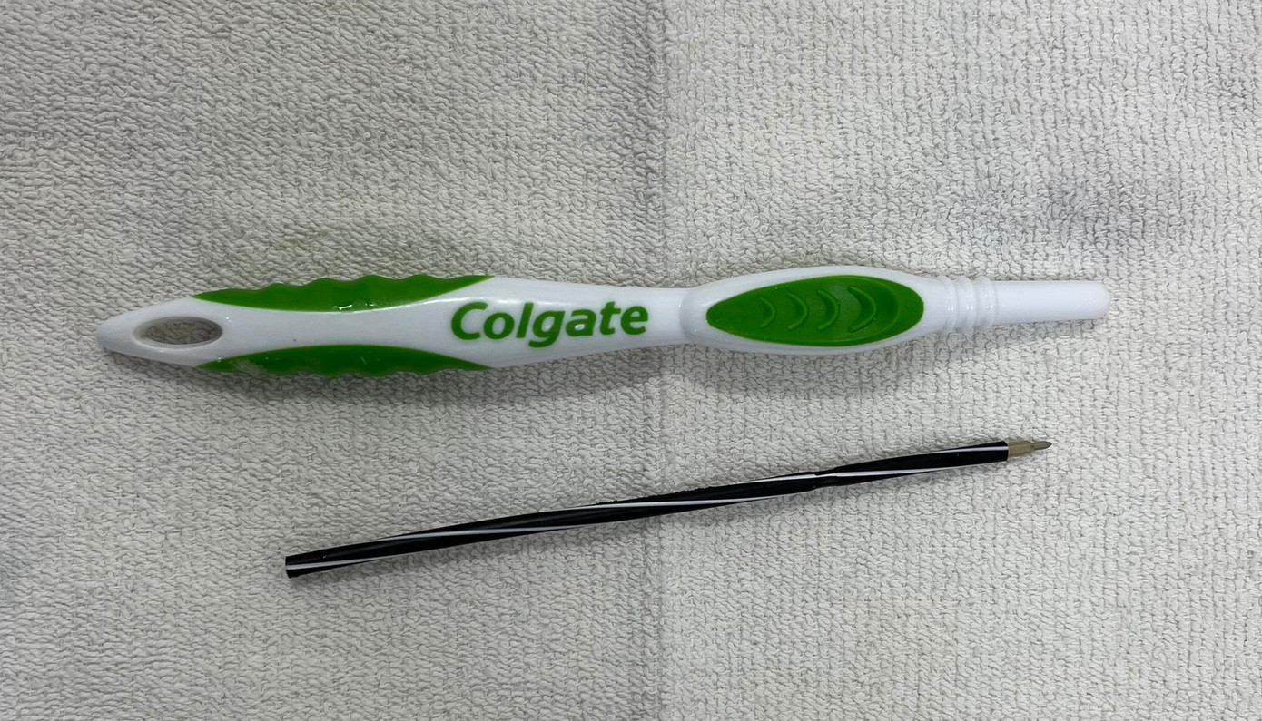 Thân bàn chải và ruột bút bi được các bác sĩ lấy ra khỏi dạ dày bệnh nhân. Thân bàn chải và ruột bút bi được các bác sĩ lấy ra khỏi dạ dày bệnh nhân.