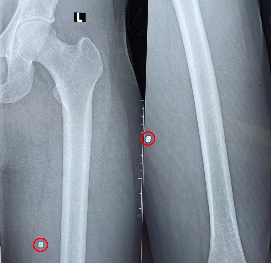 Hình ảnh đầu đạn trên phim Xquang. Hình ảnh đầu đạn trên phim Xquang.