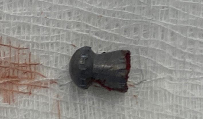 Viên đạn được lấy ra thành công. Viên đạn được lấy ra thành công.